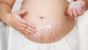 Pregnancy Stretch Marks Removal Cream